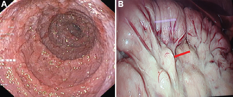 (A) Upper gastrointestinal endoscopic picture showing severe duodenal fissuring. (B) Laparoscopic picture showing ileal loops with enlarged mesenteric lymph nodes (red arrow).